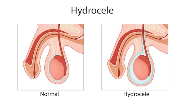 hydrocele-male-reproductive-system-penis-medical-vector-illustration_313437-1379